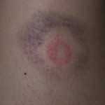 Rubber Bullet Wound